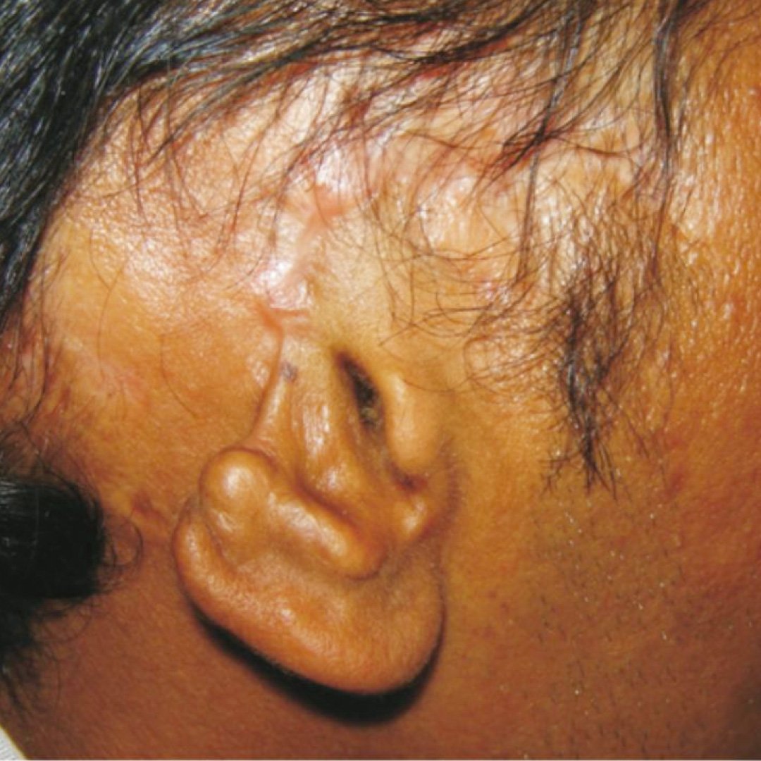 Ear2