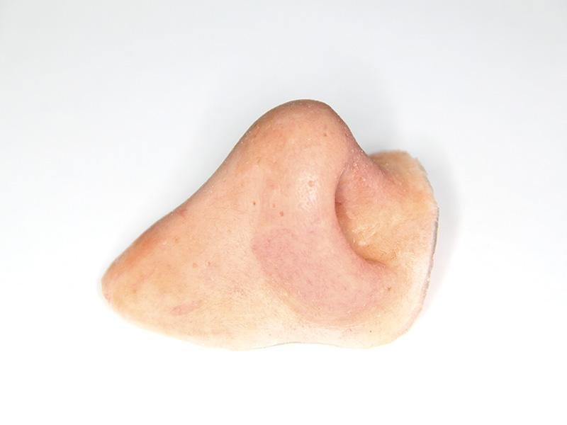 Nose Prosthesis