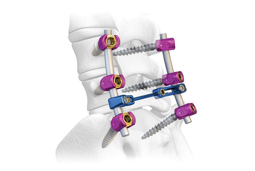 Spine Implants